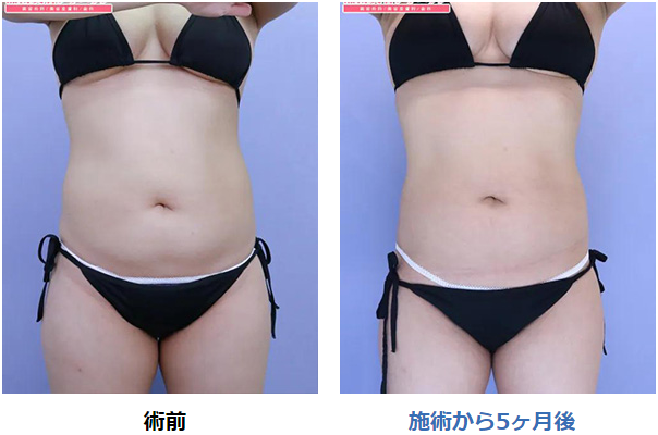 クールスカルプティング安いおすすめ