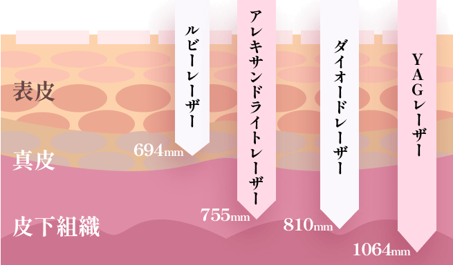 ジェントルマックスプロの医療脱毛とは