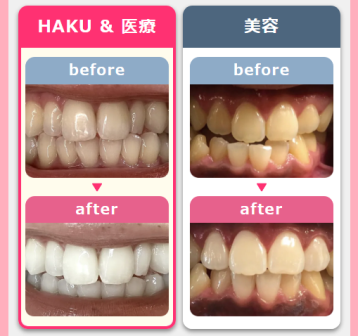 メディカルホワイトニングHAKU（HAKUホワイトニング）の効果